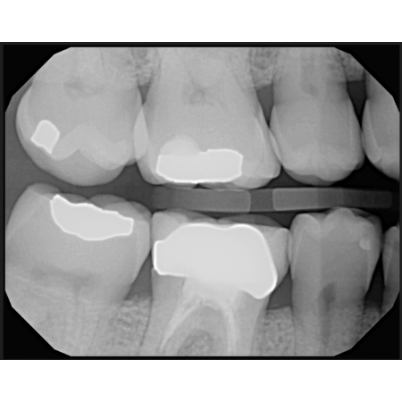 CARINA 1.5 Digital Intraoral Sensor